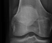 Bipartite patella Superolateral